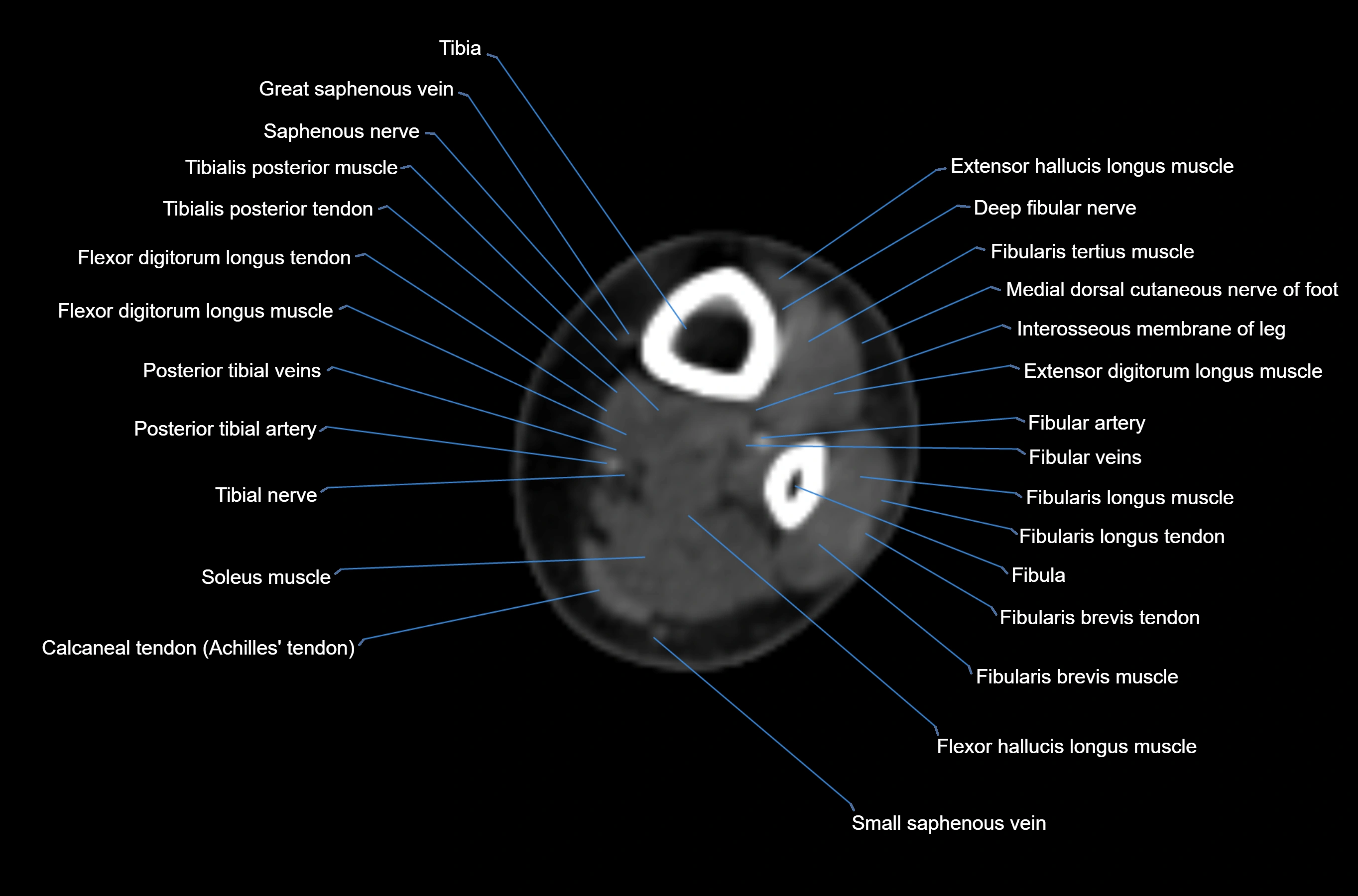 CT Ankle axial cross sectional anatomy labelled image -00003.webp